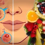 7 أطعمة تسبب حب الشباب