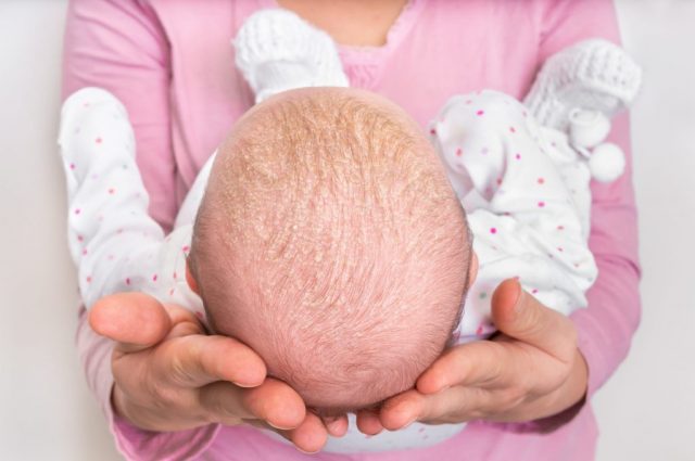 ما هي أعراض الصدفية عند الرضع ؟
