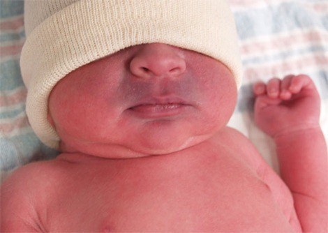 ما أسباب زرقان الشفايف عند الأطفال الرضع؟