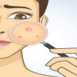 كيفية علاج آثار الحبوب ؟