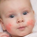 ما هي أعراض حساسية البيض عند الرضع؟