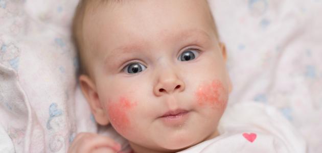 ما هي أعراض حساسية البيض عند الرضع؟