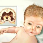 أعراض تلف الدماغ عند الرضع