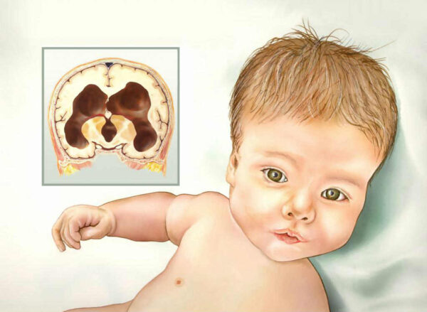 أعراض تلف الدماغ عند الرضع