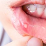 ما هي أسباب تقرحات الفم المتكررة ؟