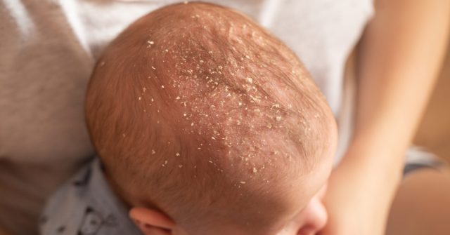 أسباب خبز الرأس عند الرضع وعلاجه