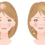 أسباب تساقط الشعر المفاجئ