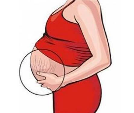 متى تبدأ تشققات البطن عند الحامل؟