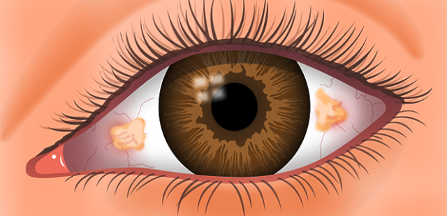 ما أسباب جفاف العين بعد الليزك؟