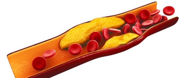 ما اعراض ارتفاع الكوليسترول في الدم ؟