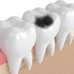 ما الأطعمة التى تسبب تسوس الأسنان والتهاب اللثة؟