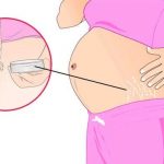 ما طرق الوقاية من تشققات الحمل ؟