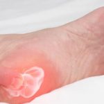أسباب وطرق علاج مسمار القدم